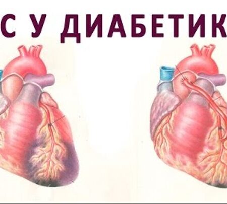 Новые данные о влиянии диабета второго типа на сердце