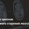 Выявлен биомаркер ускоренного старения мозга
