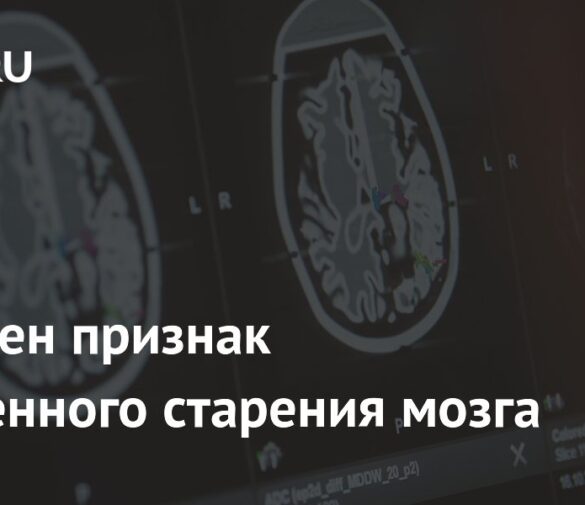 Выявлен биомаркер ускоренного старения мозга