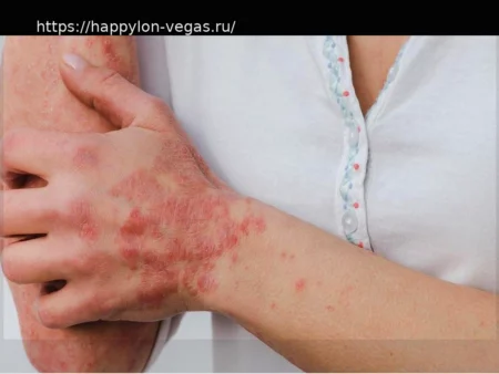 TREX2: новая мишень для лечения кожных заболеваний