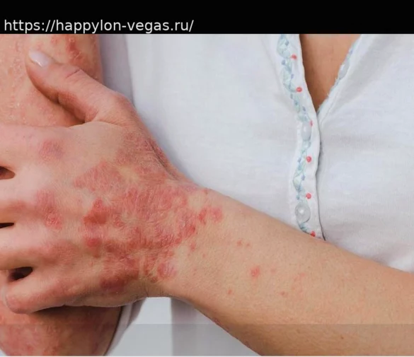 TREX2: новая мишень для лечения кожных заболеваний